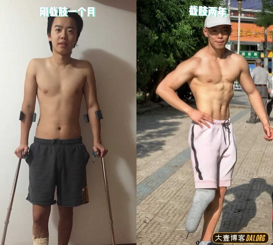 成都小伙截肢后的五年,越挫越勇,励志健身变型男,终抱得美人归 成都小伙截肢后的五年,越挫越勇,励志健身变型男,终抱得美人归
